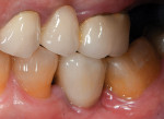 Full-contour zirconia implant crown seated intraorally.