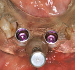 Figure 14e  NobelGuide in place,implants inserted.