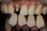 Figure 14  Choosing the chroma on a patient case. The same image can be used to determine if the teeth are redder or yellower than the M hue group shown.