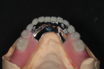 A laser-sintered framework from Zedan Dental Lab and Turbyfill Dental Laboratory.