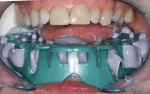 Figure 5  The full-arch impression was placed in the mouth using cheek retractors.