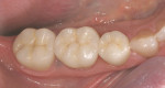 Figure 11  The final restorations in the mouth.