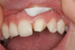 Figure 1  Tooth No. 9 after the loss of an old composite veneer.
