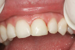 Figure 2  Tooth No. 9 after reattachment of an old composite veneer and reshaping to reduce overcontours.