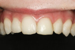 Figure 3  Pretreatment view, revealing asymmetry of the central incisors.
