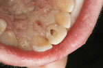 Figure 4  Endodontic access opening on the lingual of tooth No. 9.