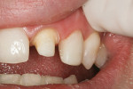Figure 10  New composite veneer on tooth No. 10 which lengthens the tooth, repositions the incisal edge, and increases width by adding to the mesial surface.