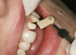 Figure 12  Matching the dentin shade.
