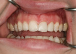 Figure 13  After cementation of IPS® Empress crown on tooth No. 9.