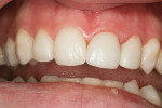 Figure 14  Close-up of the new crown on tooth No. 9.