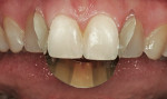 Figure 10  Matrix placed prior to insertion of central incisors.