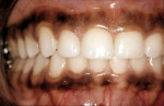 Figure 4  This patient exhibited considerable squareness of her maxillary central and lateral incisors.