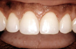 Figure 5  Esthetic crown lengthening uncovered significantly more of the clinical crowns.