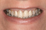 Figure 2  Preoperative view of the smile revealing discolored teeth, composite restorations, and crowns (Note: image was taken after extraction of tooth No. 8).