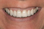Figure 13  Postoperative view of the patient’s natural smile.