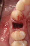 Figure 9: Coronal view of socket showing atraumatic extraction; no damage to either bone or soft tissue.
