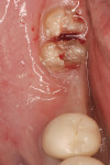 Figure 12  Non-restorable lower molar after crown removal and root separation. Both hard and soft tissue site collapse are evident in mesial site.