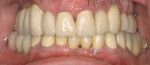 Figure 15  Anterior view of final restorations demonstrated bone and gingival reconstitution, shows bone loss on the contralateral side under the pontic.
