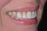 Preoperative smile (right view).