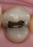 Figure 1  Tooth No. 12 showed signs of recurrent decay with mesial and distal enamel cracks.
