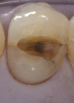 Figure 5  Pulpal floor cracking (as in this asymptomatic tooth) would have changed the treatment plan and the prognosis.