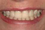 Figure 13  Final smile view.