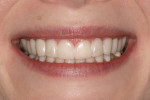 Figure 4  Immediately after placement of Snap-On Smile.