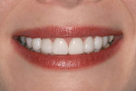 Figure 7  After 13 months of wearing the Snap-On Smile, the patient was very happy with her new LUMINEERS smile.