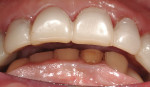 Figure 8  The anterior teeth demonstrate the restorative space created at the increase in vertical dimension.