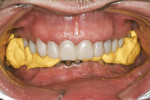 Figure 11  Registration of the molar relationship. The patient was instructed to bite half-hard; dentists must not allow overlapping of the registration material or the bite will be defective.