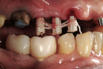 Figure 14  Provisional implant cylinders were modified to reduce the occlusal height. Floss was woven between to provide a latticework for acrylic addition.