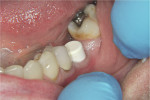 Figure 1  The abutment and white cap on tooth No. 19, post-healing and after the abutment has been torqued into place.