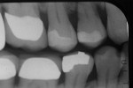 Figure 3  The radiograph of the 4-year recall seen in Figure 2.