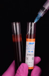Fig 16. i-PRF being drawn into a syringe from the patient’s centrifuged blood.