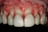 Figure 1  Panoramic radiograph of an edentulous patient treated with five endosseous titanium implants in the anterior mandible.