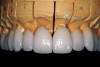 Figure 9  Laboratory occlusal view of four implant analogs with internal implant-abutment connections in a mandibular master cast. The posterior analogs replicate 5-mm diameter implant restorative platforms; the anterior analogs replicate 4.1-mm diameter implant restorative platforms.