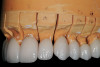 Figure 10  Occlusal view of a 7.5-mm diameter healing  abutment in an implant replacing a mandibular left first molar. The height of the healing abutment was supragingival so that the peri-implant soft tissues did not cover the occlusal aspect of the healing abutment.