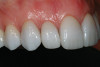 Figure 12  Occlusal view of the peri-implant soft-tissue contours around an implant replacing a maxillary right central incisor. The anatomic emergence profiles were developed by fabricating a custom provisional crown, cemented to an interim plastic abutment.