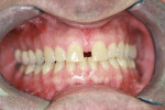 Figure 1  A large diastema between the central incisors required orthodontics and composite bonding to close spaces.