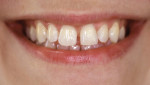Figure 2  Diastemas between the maxillary teeth, and lateral incisors that do not have a similar form to the central incisors.