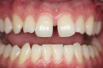 Figure 4  A large diastema existed between the central incisors. The lateral incisors were severely worn.