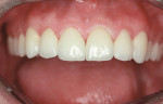 Figure 5  Bonded porcelain restorations closed the spaces and restored lost tooth structure.