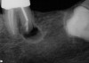 Figure 2  A premolar cantilevered pontic with a guide plane and rest on the adjacent restoration.