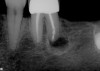 Figure 3  Recurrent caries under a cantilevered pontic rest.