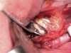 Figure 4  Cantilevered pontic replacing a mandibular lateral incisor where a conventional resin-bonded fixed partial denture had failed. The patient did not desire to have the central incisor prepared for a crown, and the canine had a long clinical crown and root with good periodontal support.