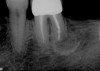 Figure 5  Cantilevered pontic replacing a maxillary second premolar where orthodontic therapy had left a small space mesial to the molar abutment, which was in good vertical alignment and had widely spaced roots with good periodontal support.