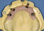 Figure 3  A master model with guide pins in place demonstrates the extreme divergence of implant position, which would compromise the ideal denture tooth position as well as significant off-axis loading.