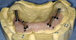 Figure 4  A master model with guide pins in place demonstrates the extreme divergence of implant position, which would compromise the ideal denture tooth position as well as significant off-axis loading.