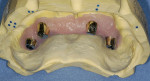 Figure 5  Laboratory-fabricated custom Konus abutments were all milled parallel to each other with a 6° taper after evaluation of ideal tooth position based on proper occlusion and esthetics.