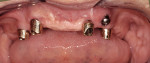 Figure 6  Primary (Konus) abutments in the mouth.